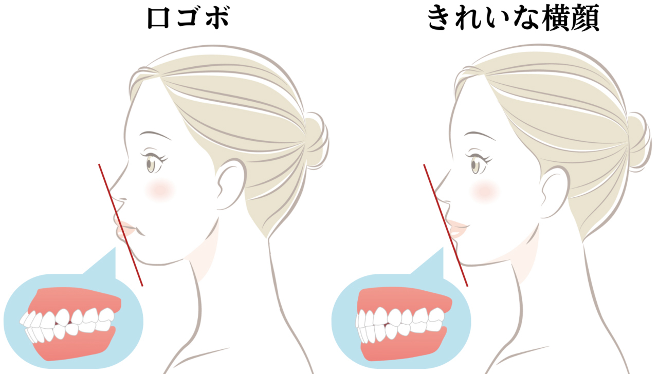 キレイな横顔と口ゴボの比較