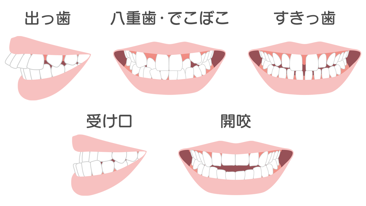あなたの歯並びもきっとキレイに軽い症状・重い症状まとめてお任せ
