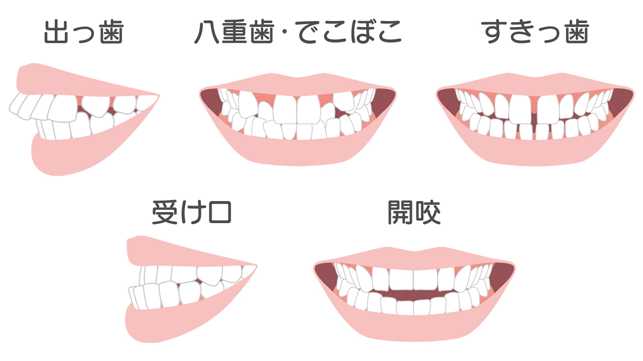 あなたの歯並びもきっとキレイに軽い症状・重い症状まとめてお任せ