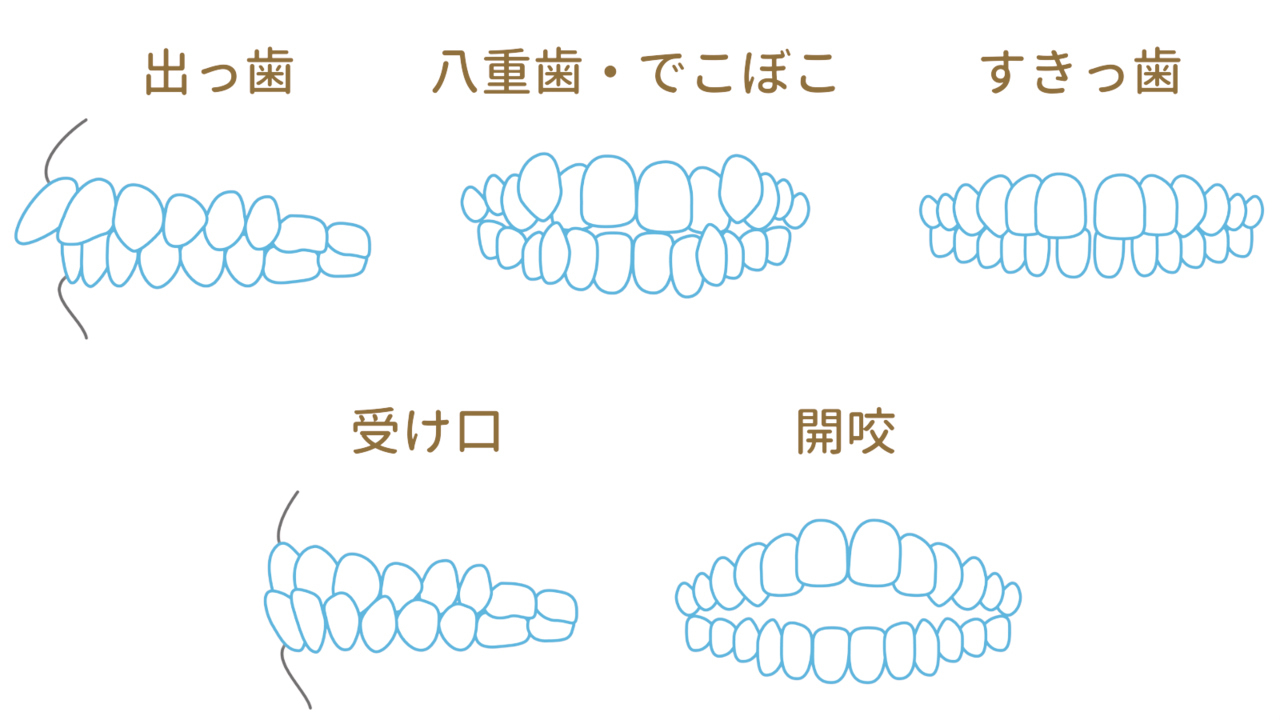 他院で断られた方もおまかせ - 西宮矯正歯科相談室（西宮・西宮市・甲陽園）