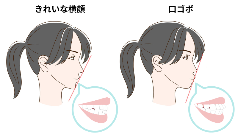 キレイな横顔と口ゴボの比較